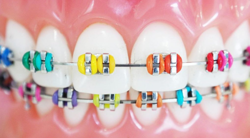 Braces in San Antonio, Texas – Expert Orthodontic Care at Amini Ortho.png