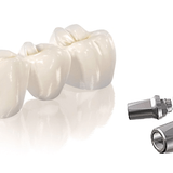 Установить временную коронку на имплант в Москве