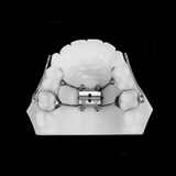 Несъёмный ортодонтический аппарат с опорой на мини винты