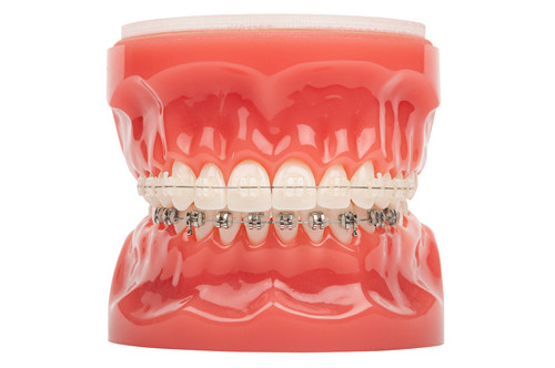 Комбинированные брекеты в Москве.jpg