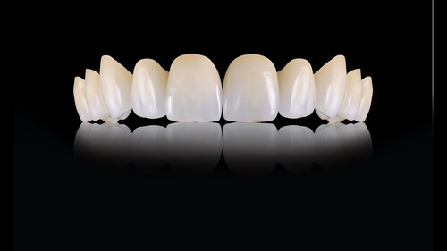 Композитные виниры в Москв.jpg