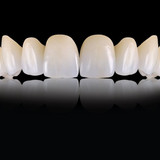 Композитные виниры в Москв