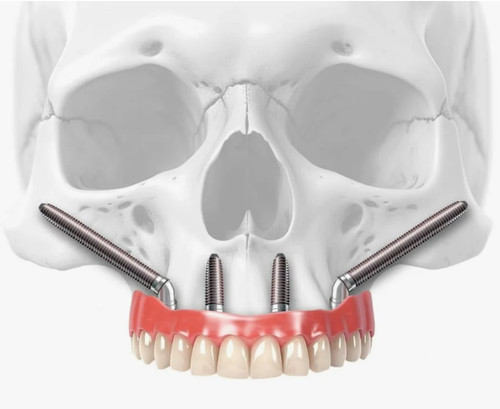 Транссинусальная установка импланта в Москве.jpg