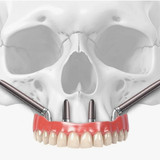 Транссинусальная установка импланта в Москве