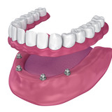 Установка 4 имплантов