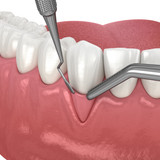 Гингивотомия, гингивэктомия в Москве