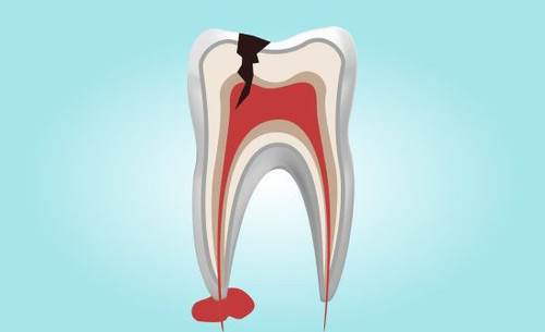 Удаление пародонтальной кисты.jpg