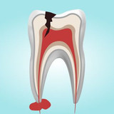 Удаление пародонтальной кисты