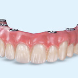 Установить постоянный акриловый протез «Всё на 4» на имплантах Osstem в Москве