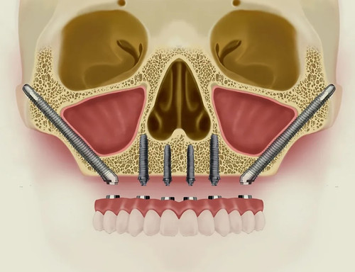 Трансназальная установка импланта в Москве.jpg
