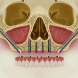 Трансназальная установка импланта в Москве