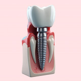 Имплантация Nobel Biocare с циркониевой коронкой