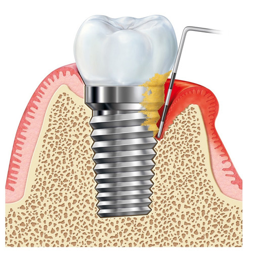 Лечение периимплантита.jpg