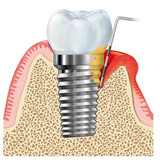 Лечение периимплантита