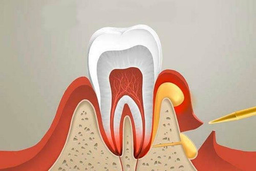 Цистотомия, цистэктомия, удаление кисты зуба.jpg