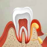 Цистотомия, цистэктомия, удаление кисты зуба