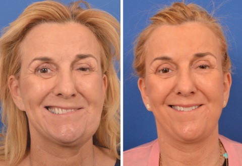 Facial Paralysis Surgeon CA.jpg