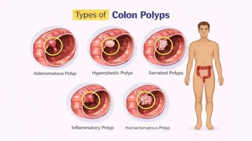 Types Of Colon Polyps.png