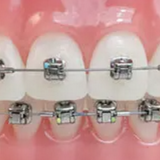 affordable palate extension.png