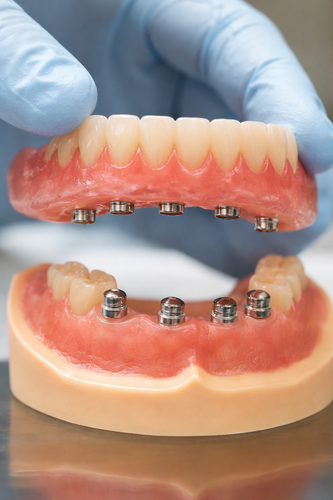 Implant Overdentures.png