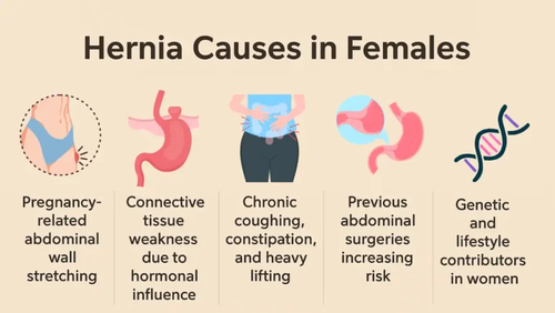Hernia Causes In Females.png