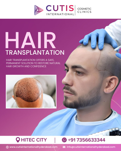 Why Choose Hair Transplantation for Permanent Hair Growth?.jpg