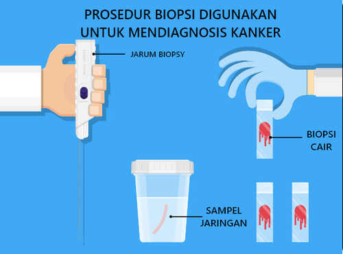 Biopsy procedures used to diagnose cancer.png