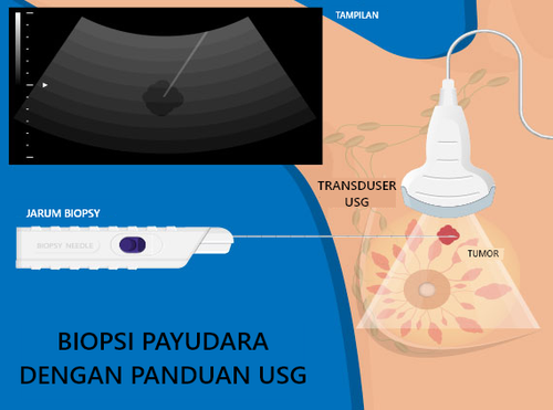Ultrasound guided breast biospy.png