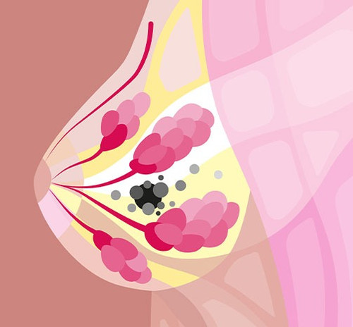 Why do I have breast lumps.jpg
