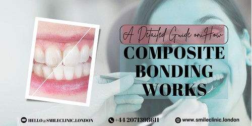A Detailed Guide on How Composite Bonding Works Transform Your Smile with Precision.jpg