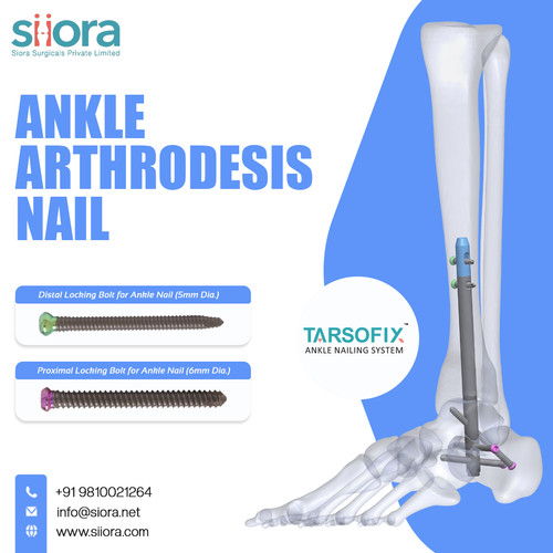 Ankle Arthrodesis Nail.jpg