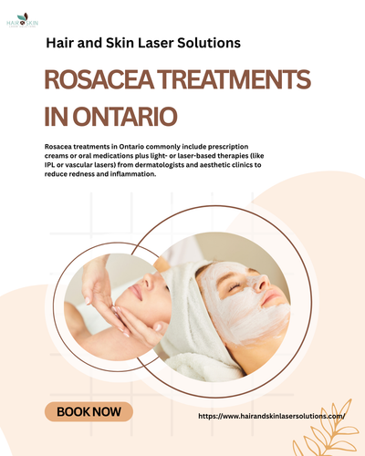 Rosacea Treatments in Ontario.png