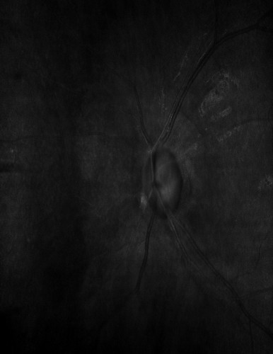 slo fundus 06918.jpg