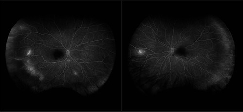 susac syndrome 28.jpg