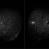 susac syndrome 28