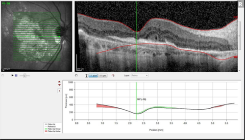 outer retinal tubulation 2.png