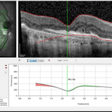 outer retinal tubulation 2