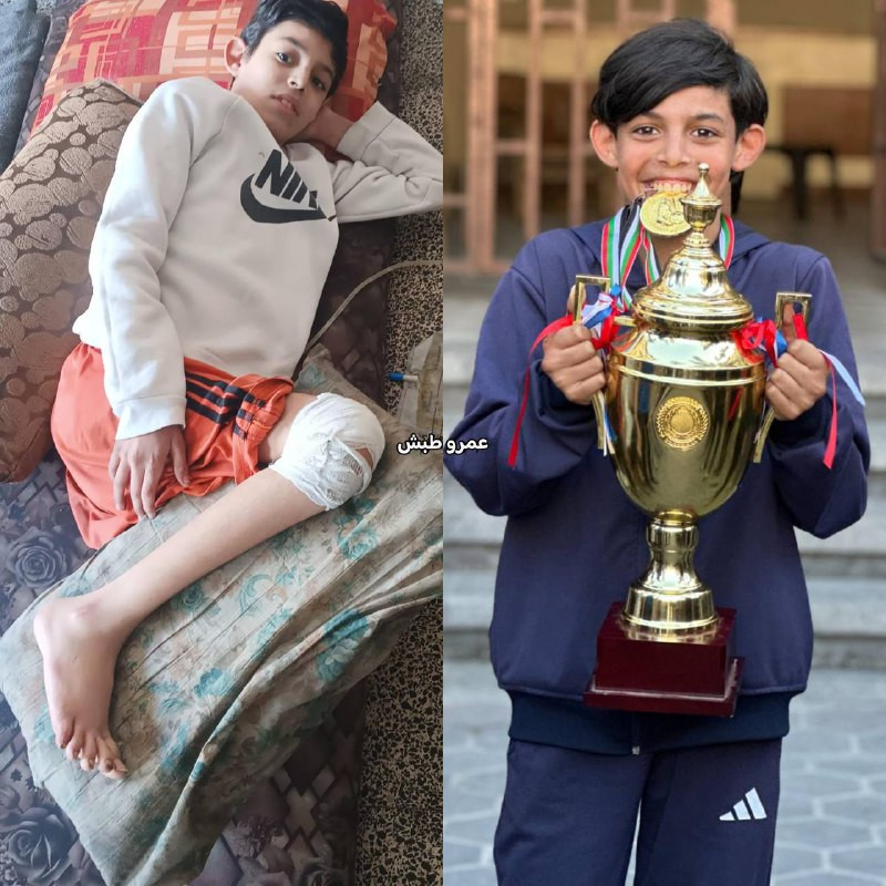 من لاعب موهوب إلى عاجز عن الحركة

▫️الطفل مهند التلمس (15 عامًا)، أصيب بشلل نصفي بعد تعرضه لشظايا في العمود الفقري نتيجة قصف إسرائيلي، ما أدى إلى كسور...