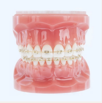 Where can I get affordable braces in Lenexa?.png