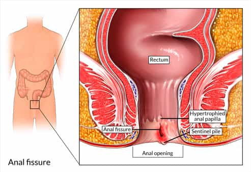 Fissure Treatment in Delhi NCR.jpg