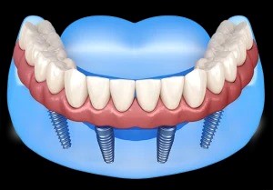 full mouth teeth replacement.jpg