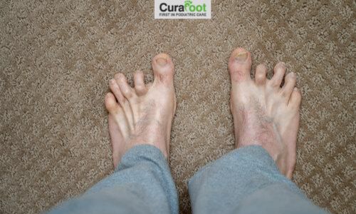 Understanding Hammertoes and How to Treat Them Effectively.jpg