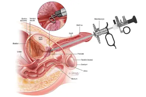Best Prostate Cancer Treatment in Delhi.webp