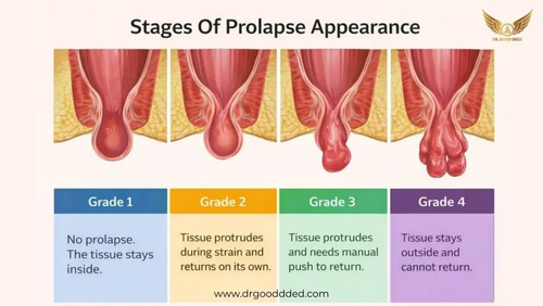 What Prolapsed Hemorrhoids Look Like.png