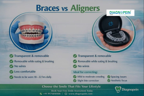 Dental Braces VS Aligners.jpg