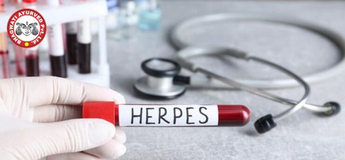 Herpes Simplex Treatment in Telangana - Bhagwati Ayurved.jpg