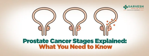 prostate cancer stages explained what you need to know.png