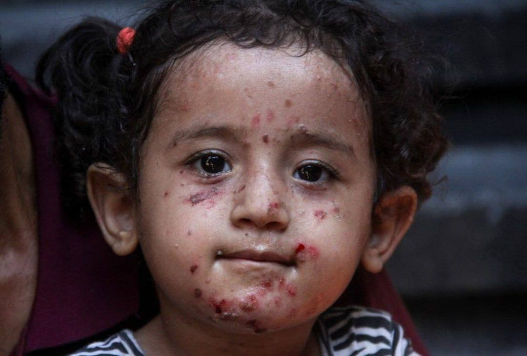 مستشفى الشفاء: تحذير من تدهور صحي متسارع وتفشّي أمراض غير مشخصة

▪ إدارة قسم الاستقبال والطوارئ تؤكد ارتفاعًا غير مسبوق في أعداد المراجعين، مع استقبال...