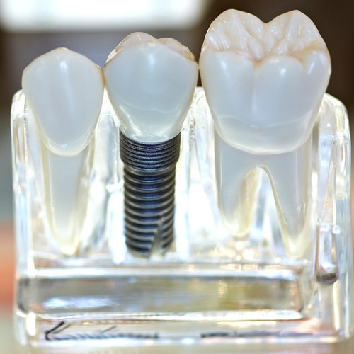 Керамическая коронка на диоксиде циркония.jpg