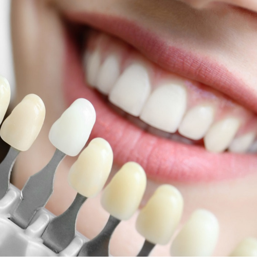 Керамический винир (диоксид циркония).png